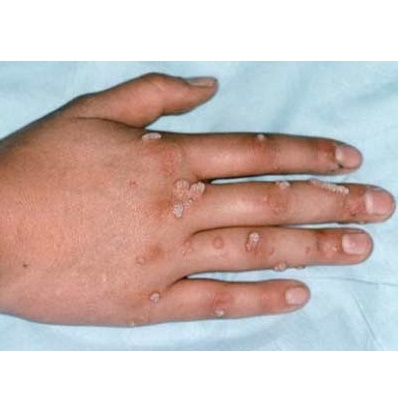 Hình ảnh bệnh nhân bị Hạt cơm ở tay (mắt cá, mụn cơm) do nhiễm Human Papilloma Virus